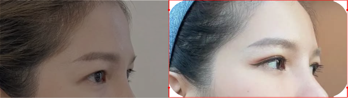 미국 유럽 눈성형 전후