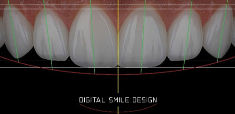 디지털 스마일 디자인