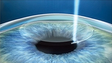 레이저 시력교정