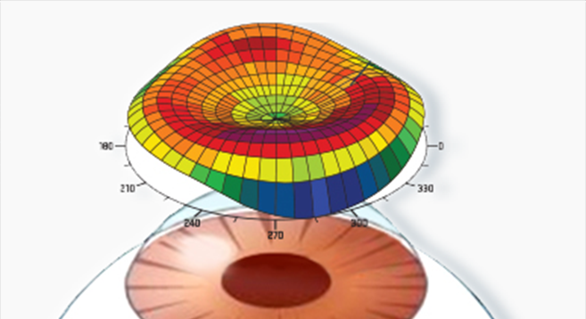 컨투라 원데이 라식