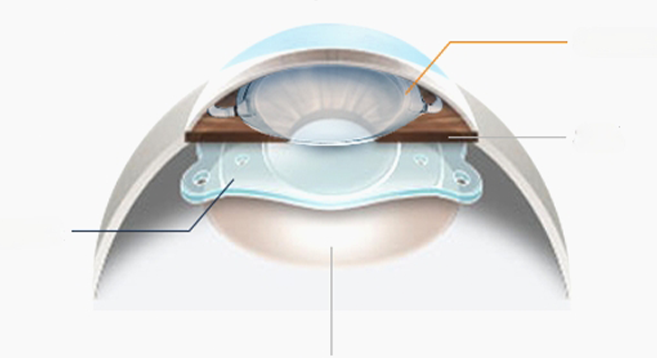 안내렌즈삽입술