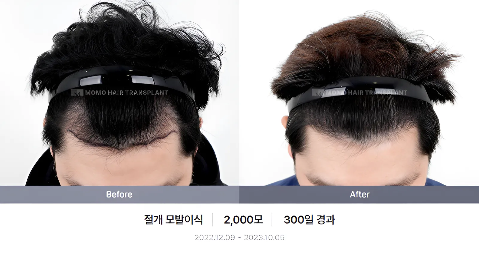 절개 비포애프터 1