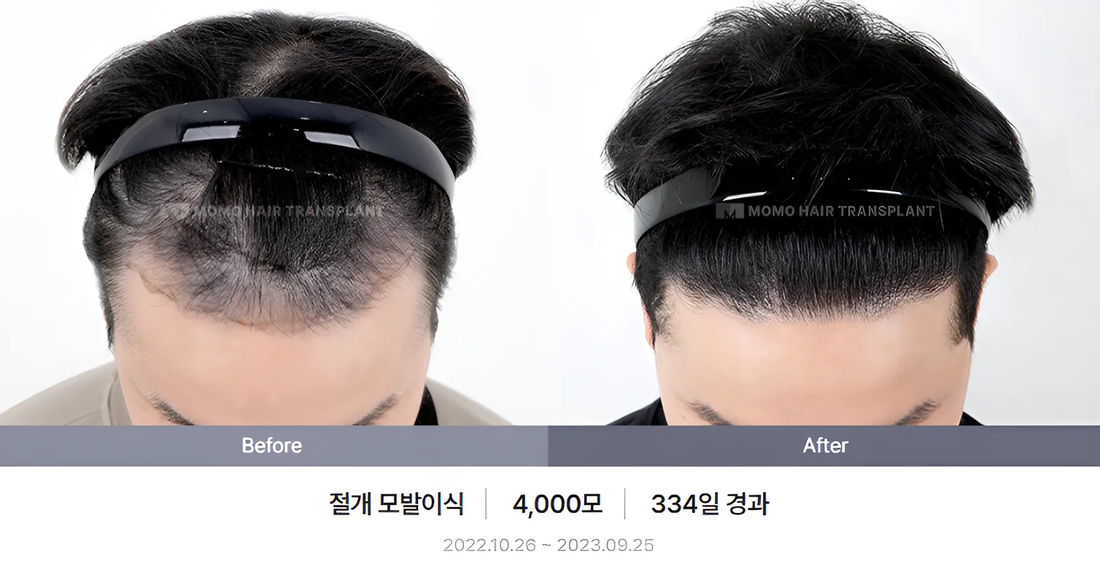 절개 비포애프터 3