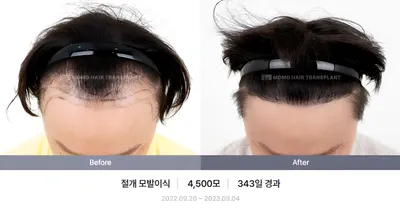 절개 비포애프터 4