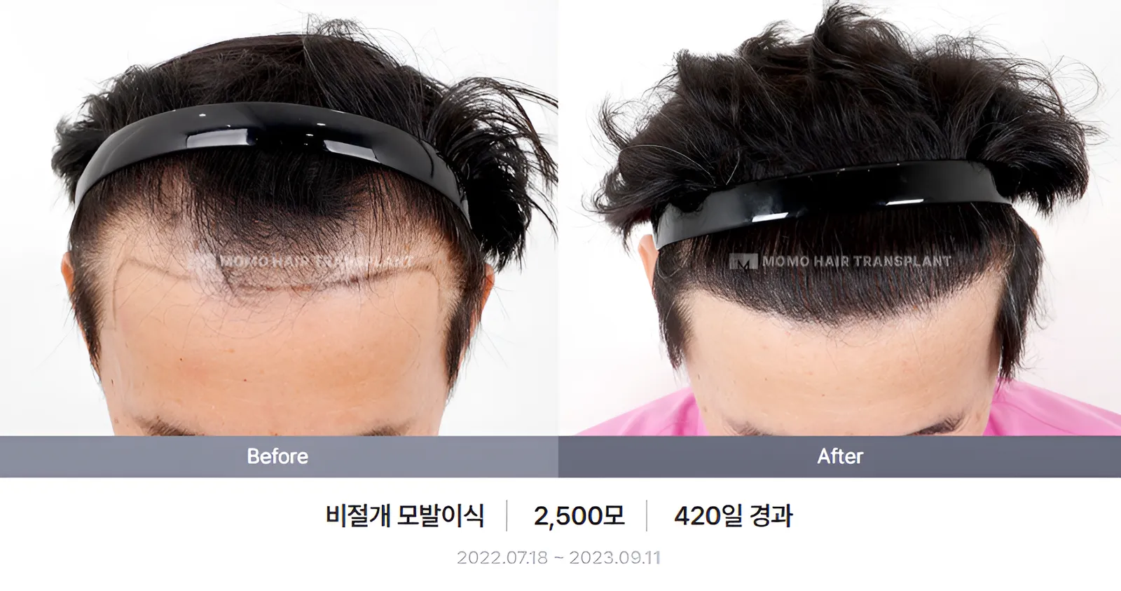 비절개 비포애프터 1