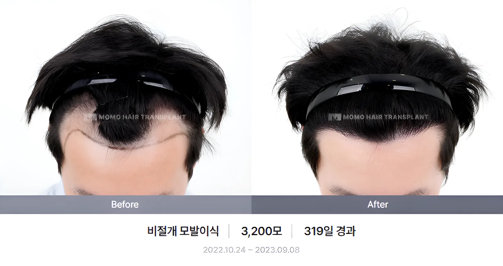 비절개 비포애프터 2