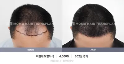 비절개 비포애프터 3