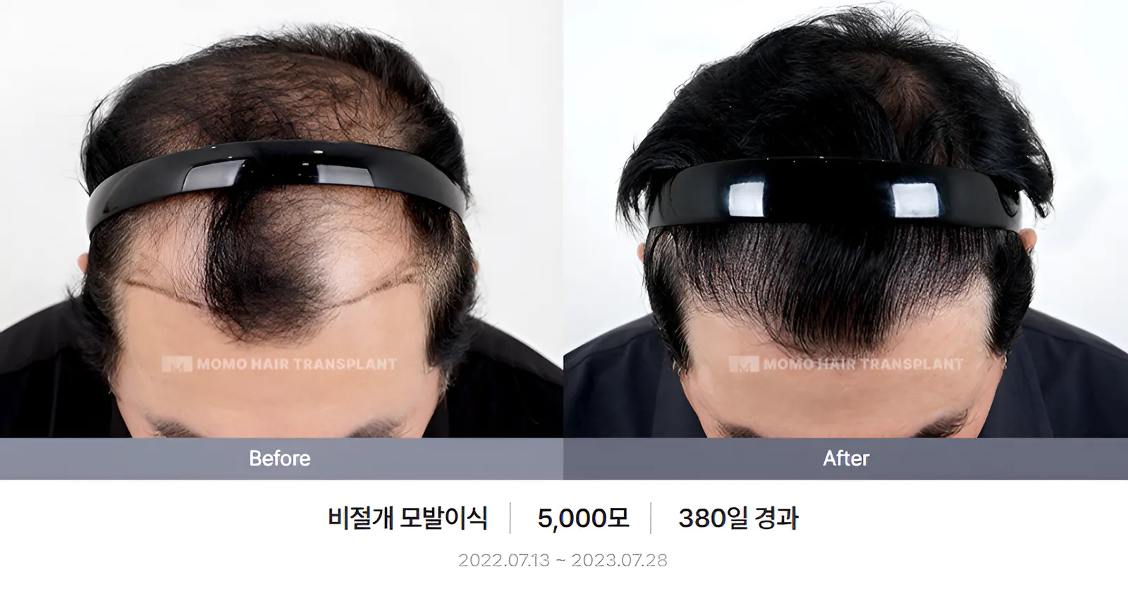 비절개 비포애프터 4