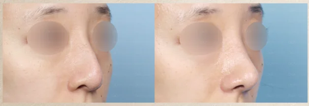 코성형 전후 사례 2
