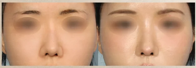 코 재수술 전후 사례 3