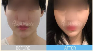 실리프팅 전후 사례 1