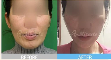 실리프팅 전후 사례 2