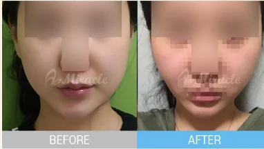 실리프팅 전후 사례 6