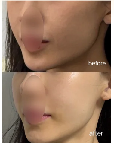 턱선 리프팅 전후
