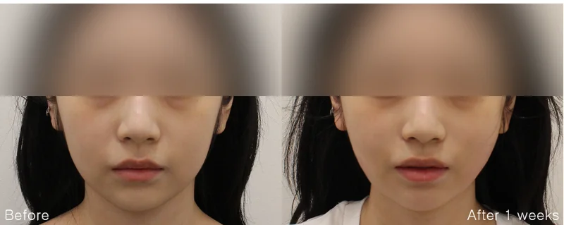 정면 시술 전후 사례